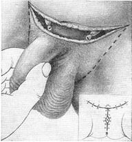 通过去除隐藏部分来延长阴茎的手术长度